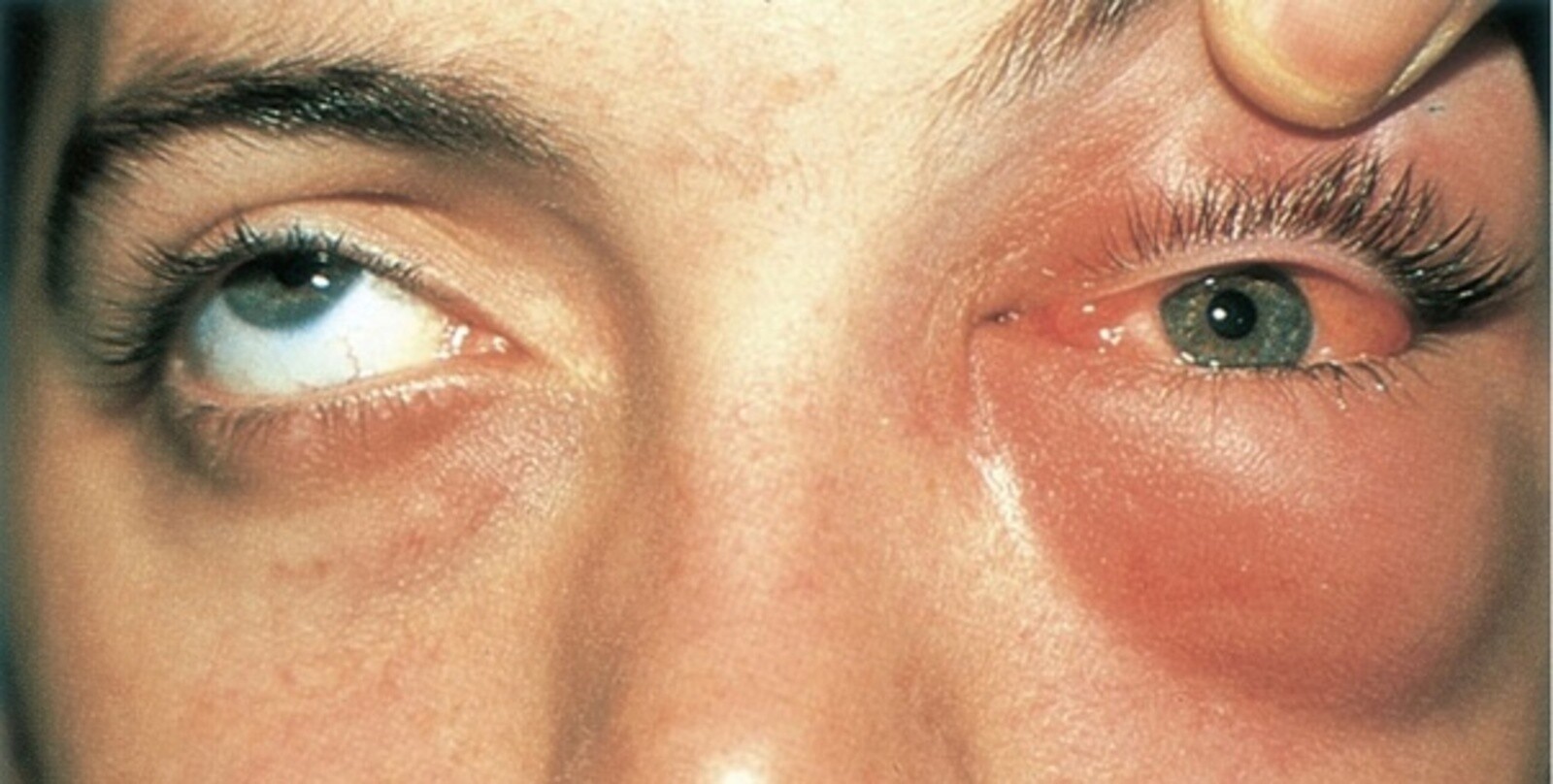 Воспалительные заболевания мягких тканей глаза