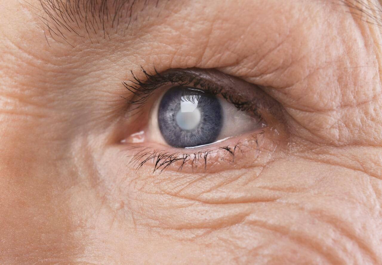 Глаукома: симптомы, диагностика и методы лечения